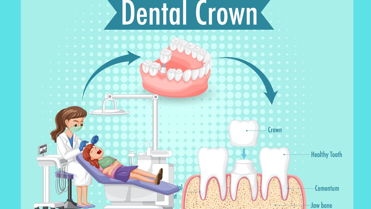 Dental Crown